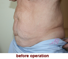 plastic-surgery-tummy-tuck